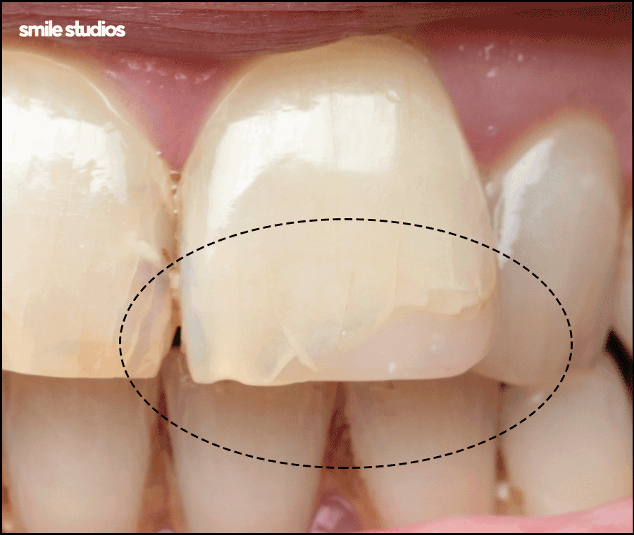 앞니부러짐 치아파절 대처 방법은? ft. 라미네이트 관련 이미지 3