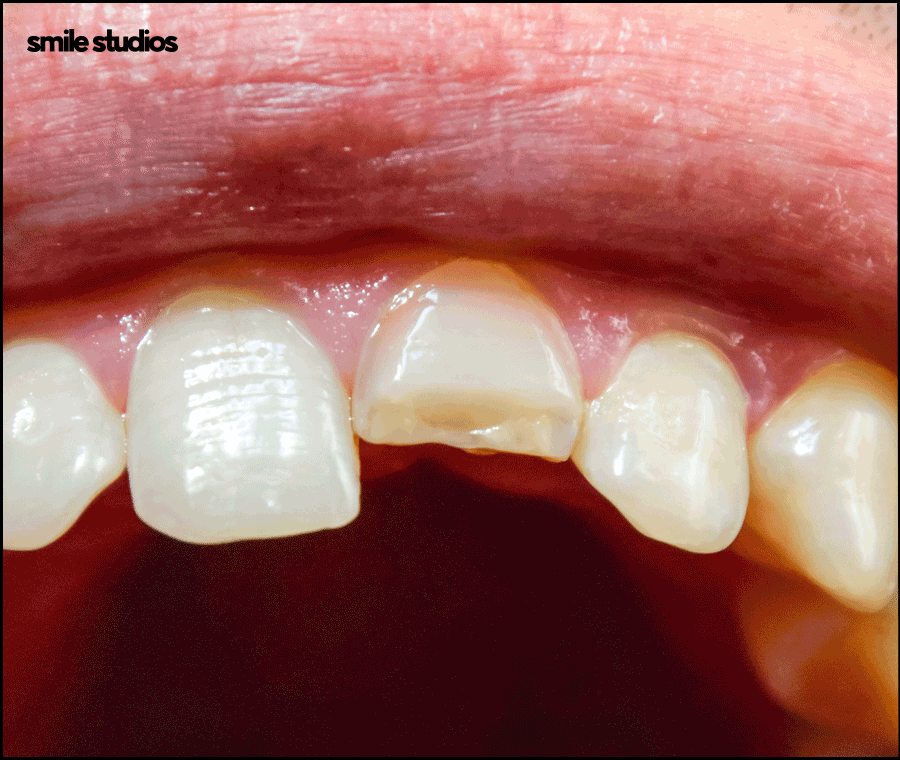 How to Restore Chipped or Fractured Front Teeth and Check the Results image 6