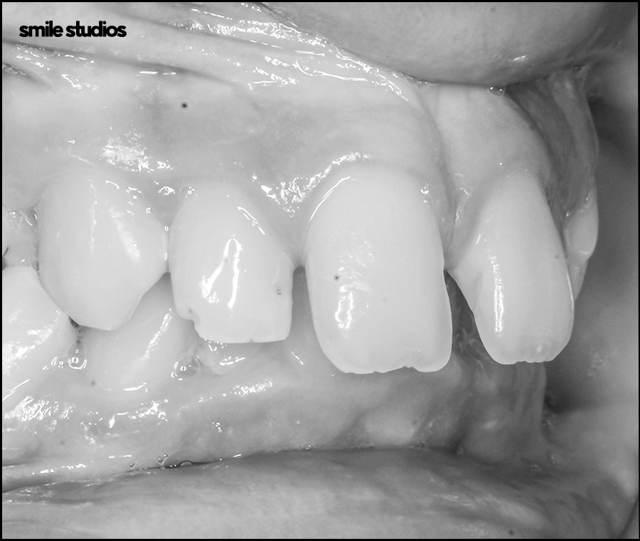 잠원동치과 치아교정 관련 이미지 4