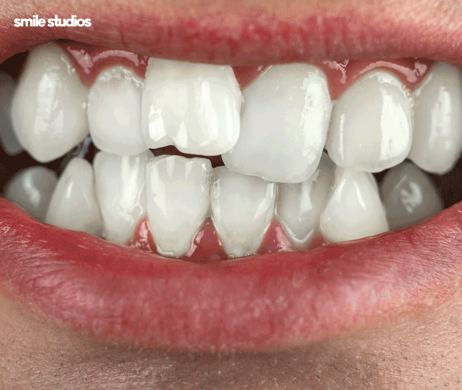 연예인 치아교정 심미성이 우수한 방법 2가지 관련 이미지 2