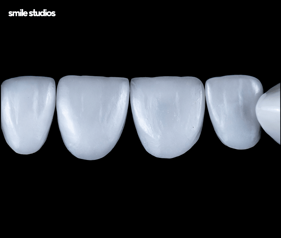 거미스마일 미소의 결함, 해결 방법 ft. 라미네이트 관련 이미지 8