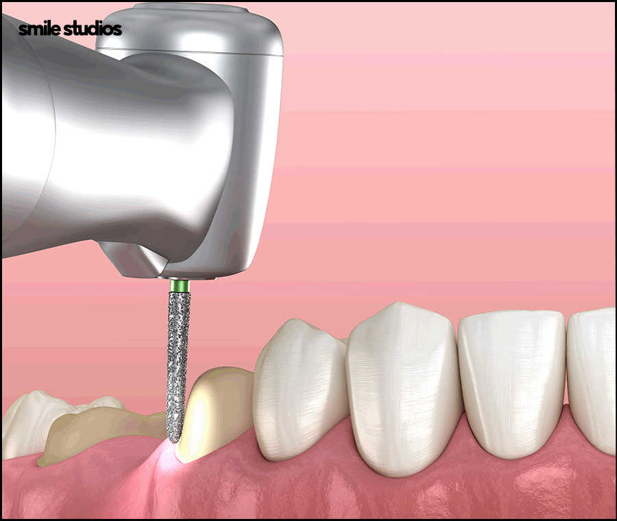 신논현역치과, 라미네이트 시술 전 꼭 확인할 핵심 2가지 관련 이미지 7