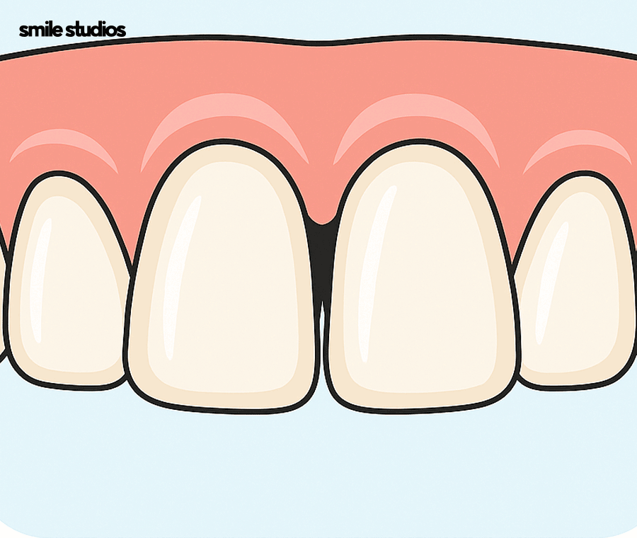 서초 신논현 치과 무삭제 라미네이트 특징, 장단점 관련 이미지 7