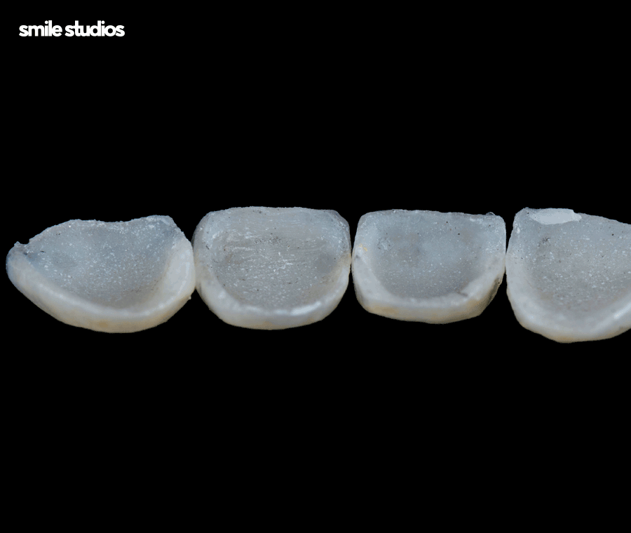 앞니 살짝 깨짐 라미네이트로 대처 가능한 수준은? 관련 이미지 8