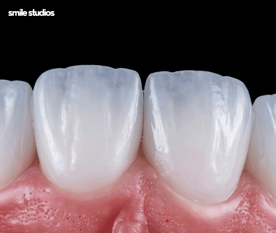 치아사이 벌어짐 가지런한 앞니 만드는 Tip 관련 이미지 9