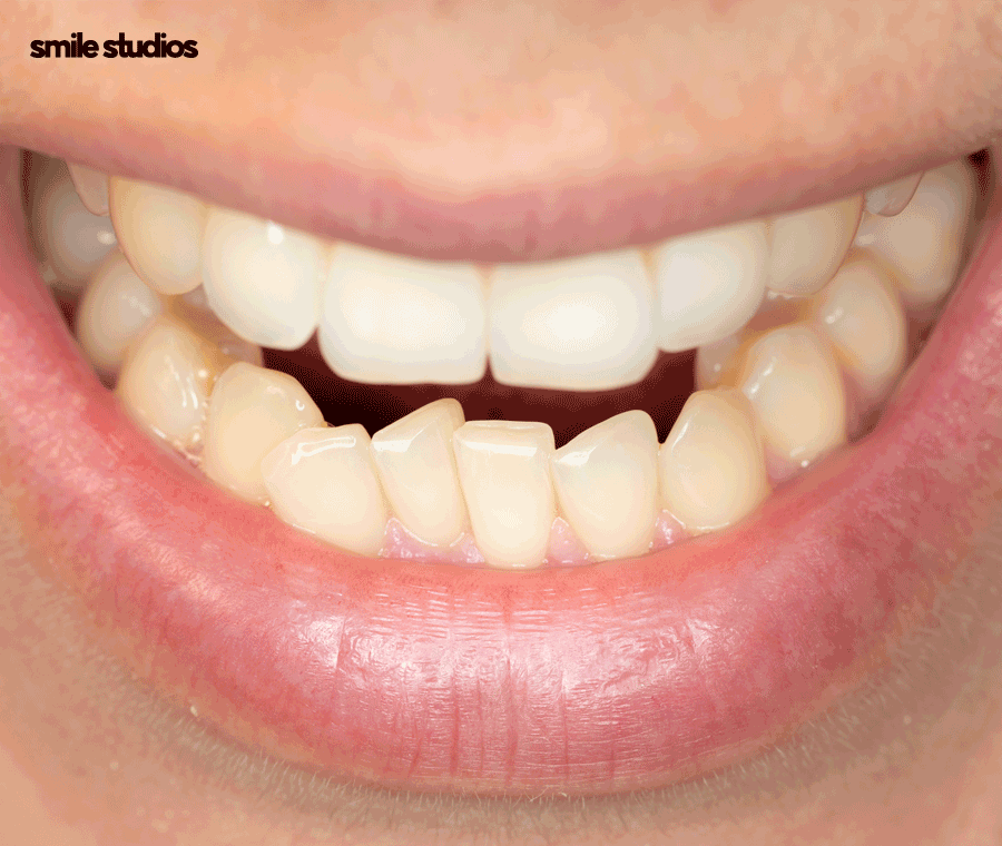 50대 치아교정 늦지 않은 이유, 방법, 효과 정리 관련 이미지 2