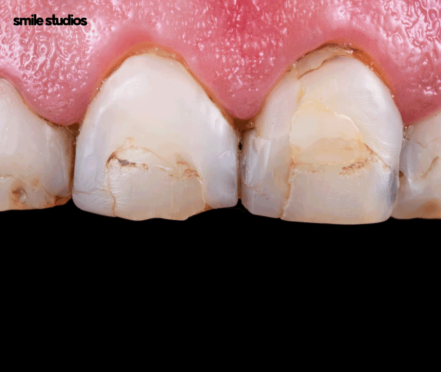 이빨깨짐 치료 치기를 놓치면 위험한 이유는? 관련 이미지 6