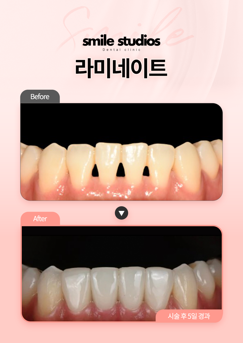 라미네이트 후기, 이것 모르면 100% 후회합니다 관련 이미지 9