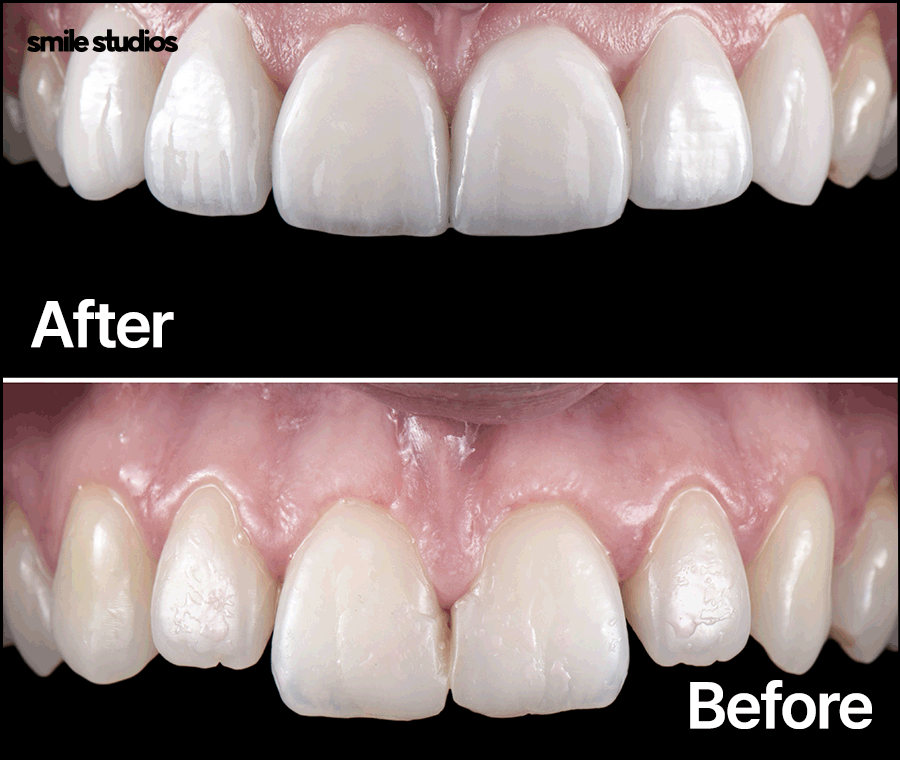 강남역 치과 라미네이트 섬세한 접근의 중요성 관련 이미지 6