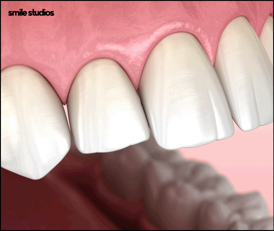 왜소치라미네이트 심미성 개선 효과, 필요성 관련 이미지 8