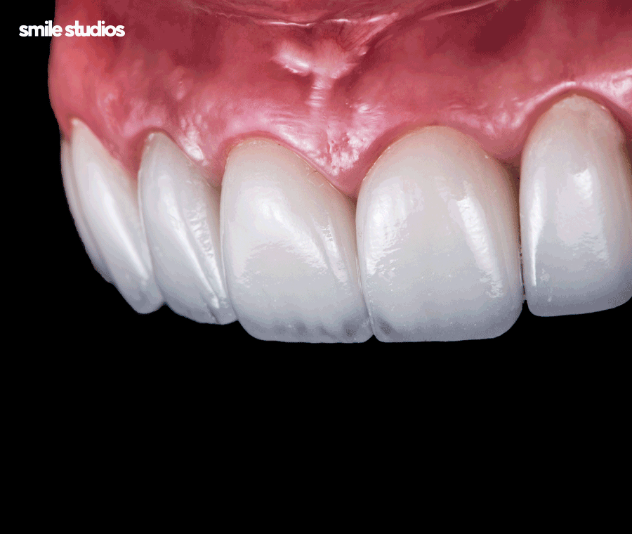 압구정 라미네이트 성공적인 결과를 만드는 핵심은? 관련 이미지 8