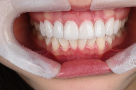 신사역치과 라미네이트 후 이미지 변화? 자연스러움의 비밀 공개! 관련 이미지 5