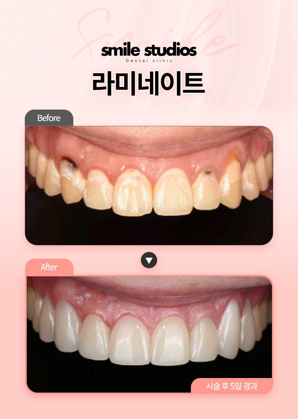 강남역치아미백, 라미네이트로 오래도록 환하게 관련 이미지 4