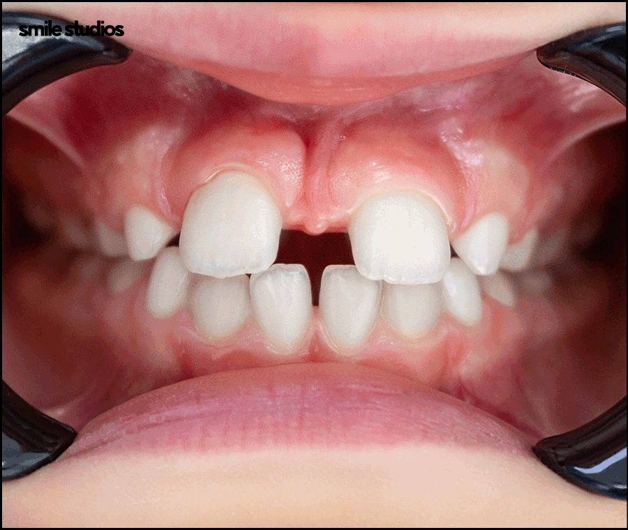 앞니 벌어짐 교정? 라미네이트? 케이스별 추천 방법 관련 이미지 5