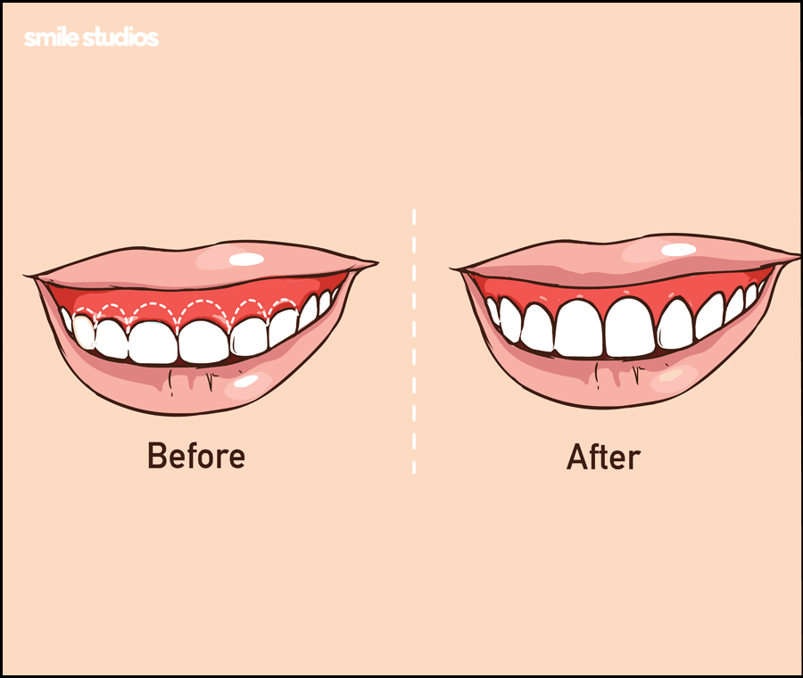 거미스마일 미소의 결함, 해결 방법 ft. 라미네이트 관련 이미지 5
