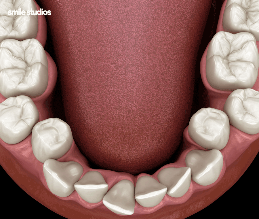 인비절라인 어태치먼트 부착 원리, 탈락 시 대처법 관련 이미지 3