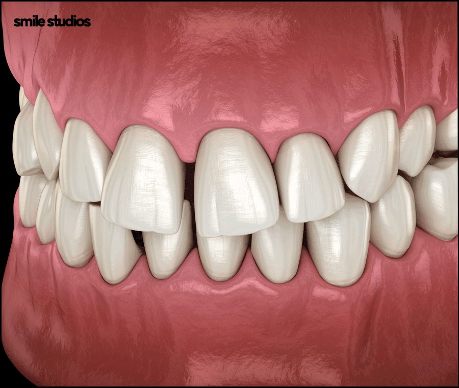 역삼역치과 인비절라인, 브라켓과 차이점 알아보기 관련 이미지 12