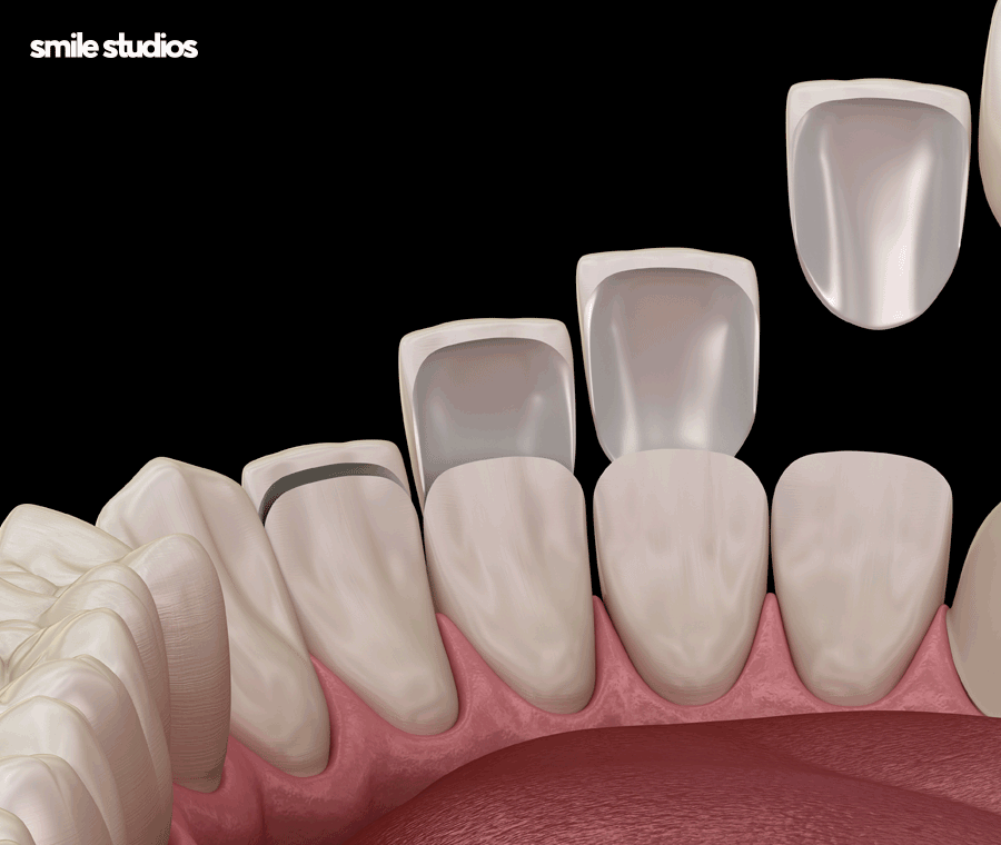 김영경 원장이 전하는 무삭제 라미네이트 A to Z 관련 이미지 5