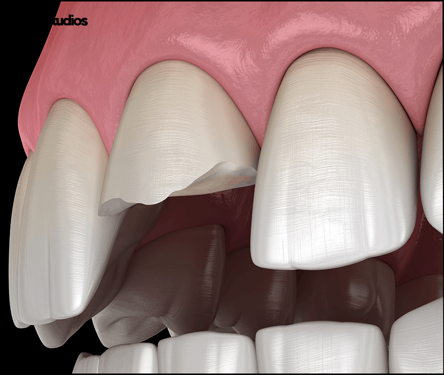 How to Restore Chipped or Fractured Front Teeth and Check the Results image 2