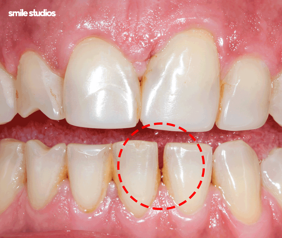 연예인 라미네이트 자연스러운 미소의 비밀은? 관련 이미지 4