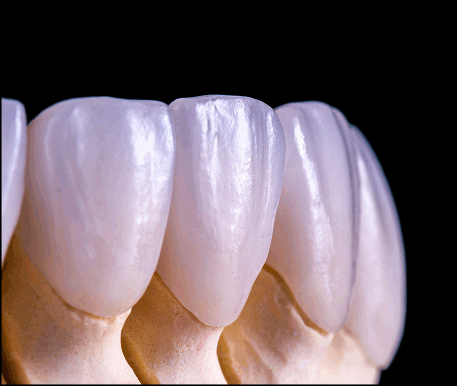 최소삭제 라미네이트 성공하려면 체크할 점 관련 이미지 7