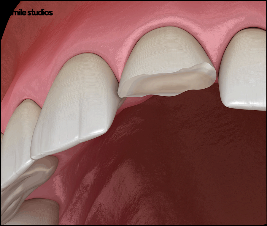깨진이빨(앞니깨짐) 라미네이트 시술 효과는? 관련 이미지 9