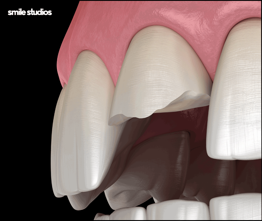 깨진이빨(앞니깨짐) 라미네이트 시술 효과는? 관련 이미지 2
