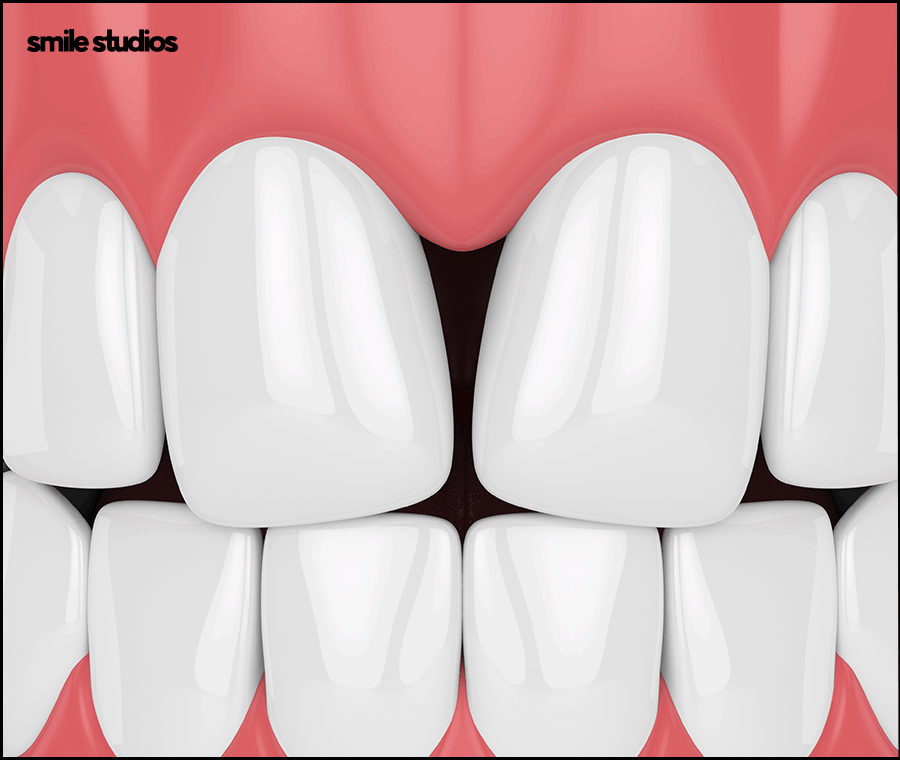 앞니 블랙트라이앵글 보완을 위한 라미네이트 효과 관련 이미지 4