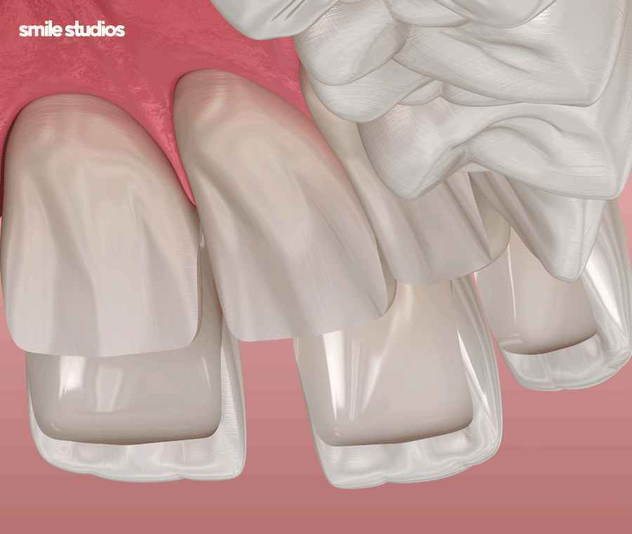 논현 라미네이트 시술 고민된다면 필수체크 관련 이미지 8