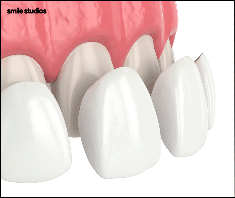 덧니라미네이트 해결 가능할까요? ft. 가능한 케이스 관련 이미지 7