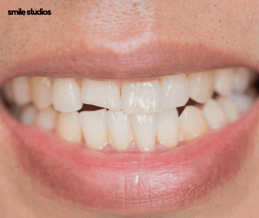 앞니 살짝 깨짐 라미네이트로 대처 가능한 수준은? 관련 이미지 6