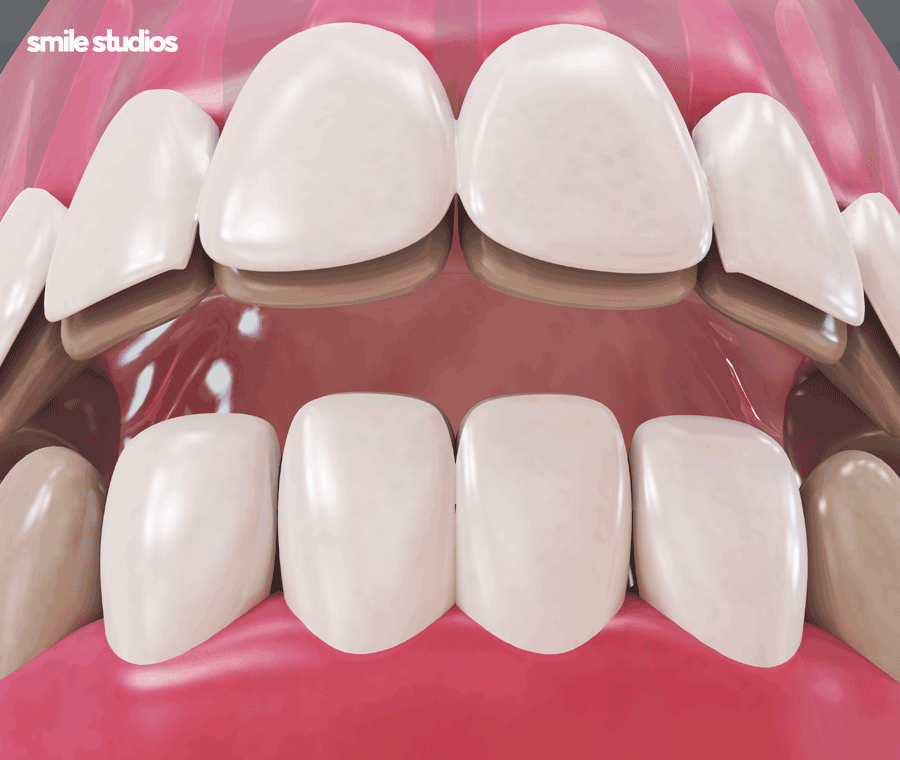 논현 라미네이트 시술 고민된다면 필수체크 관련 이미지 5