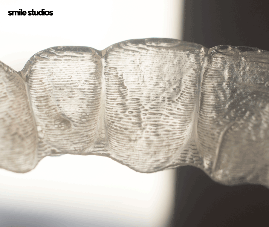 인비절라인 고무줄 착용해야 할까요? 기능 확인 관련 이미지 3