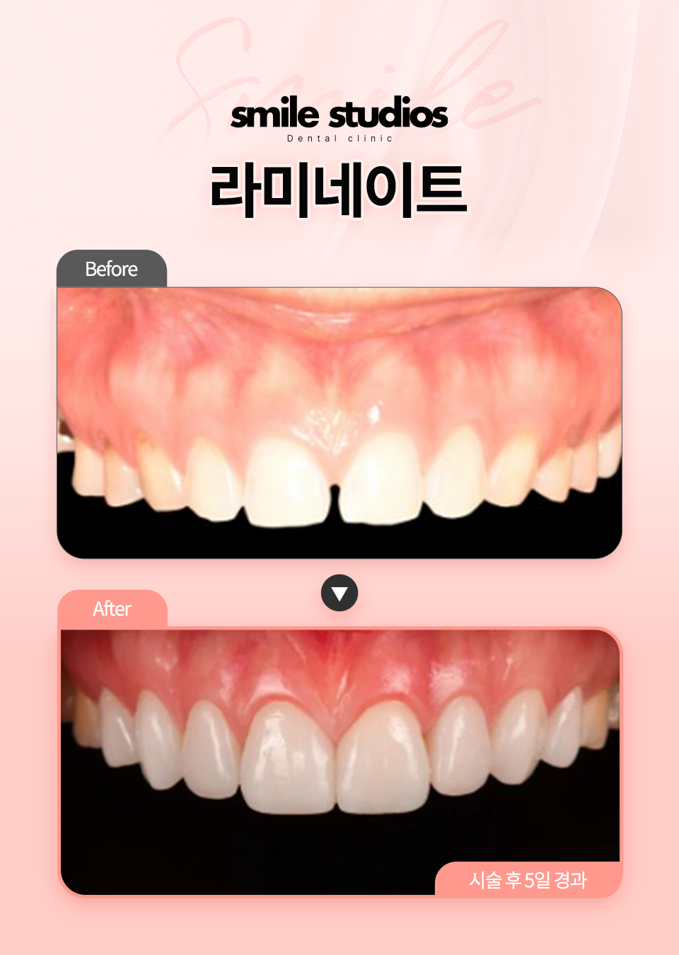서울라미네이트, 후회 없는 선택 위한 결정적 차이! 관련 이미지 9