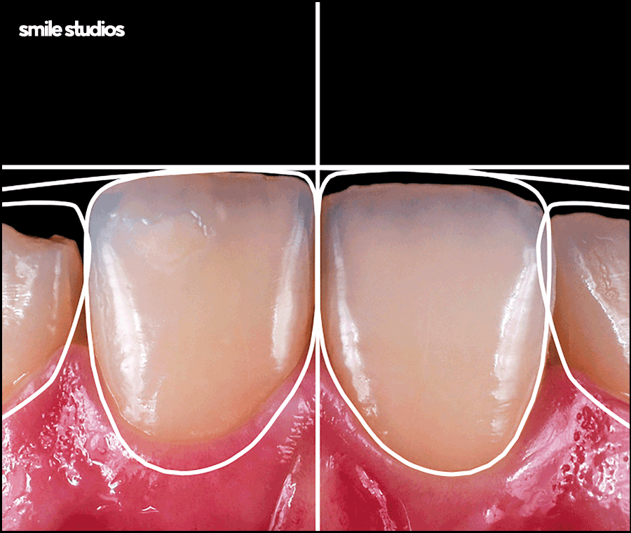 학동역치과 라미네이트 시작 전 확인해야 할 체크사항 관련 이미지 7