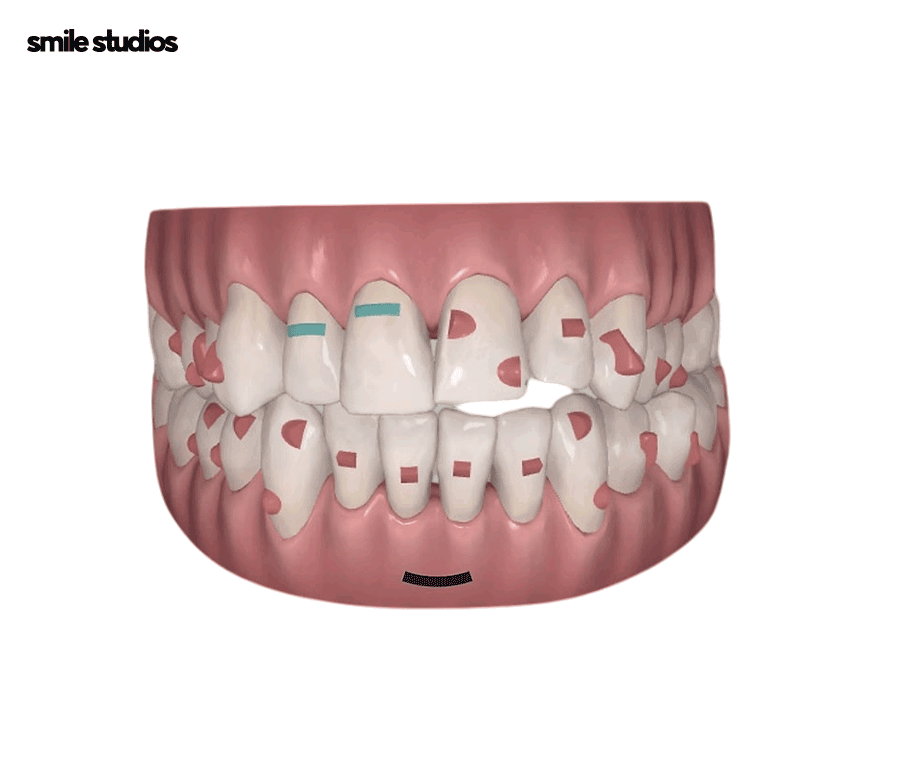 인비절라인 어태치먼트 부착 원리, 탈락 시 대처법 관련 이미지 4