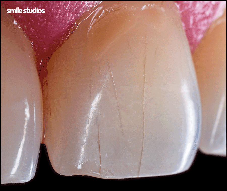 깨진이빨(앞니깨짐) 라미네이트 시술 효과는? 관련 이미지 10