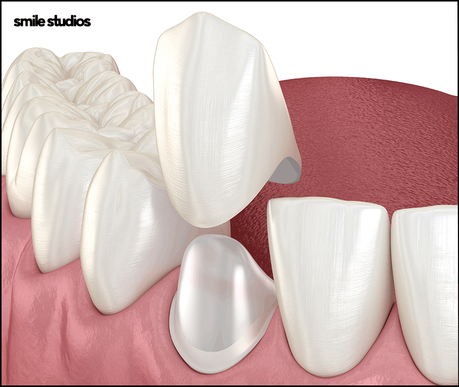 도산대로치과 앞니 라미네이트 크라운 차이점 관련 이미지 8