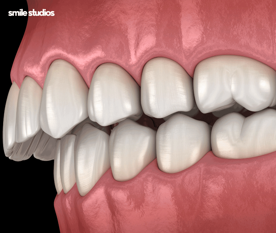 이빨교정비용 좌우하는 기준점 알아보기 관련 이미지 3