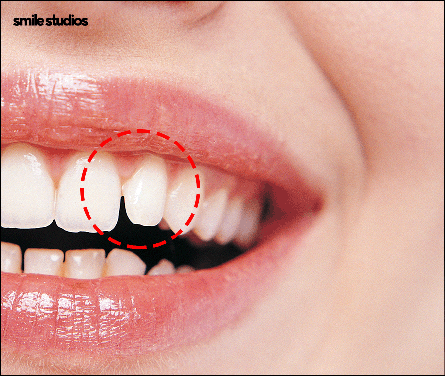 왜소치라미네이트 심미성 개선 효과, 필요성 관련 이미지 4