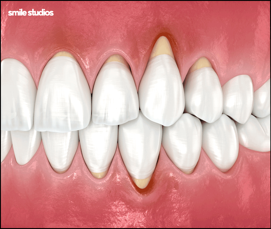 역삼역 치과, 치아 파임 증상 라미네이트 효과는? 관련 이미지 4