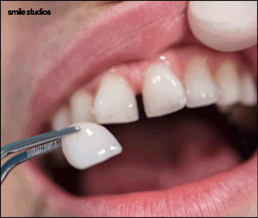 심미보철 가격, 기준, 시술 전 확인사항 총 정리 관련 이미지 8