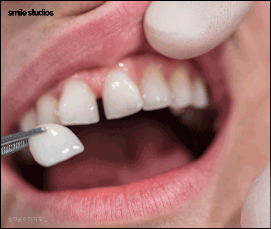 최소삭제 라미네이트 성공하려면 체크할 점 관련 이미지 2