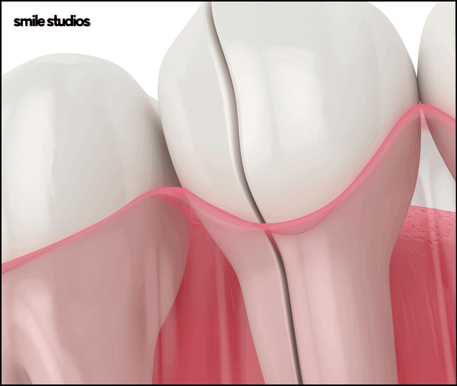 앞니깨짐 치료, 라미네이트 수복 여부, 효과 관련 이미지 7