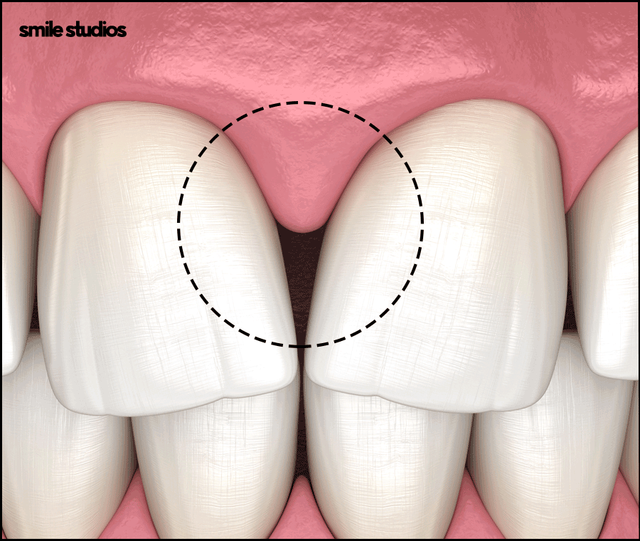 블랙트라이앵글 치료 적합한 방법 알아보기 관련 이미지 2
