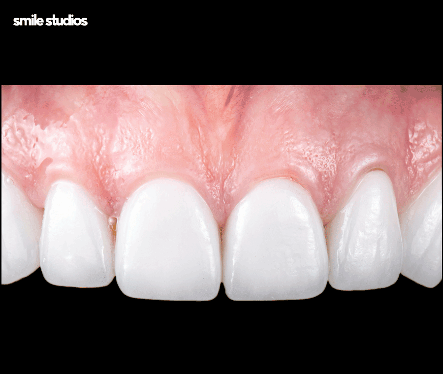 라미네이트 재시술 필요한 케이스, 주의사항 정리 관련 이미지 7