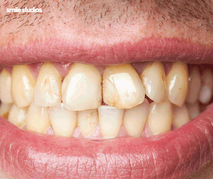 서울 논현동 치과 앞니 투명교정 장단점 총 정리 관련 이미지 4