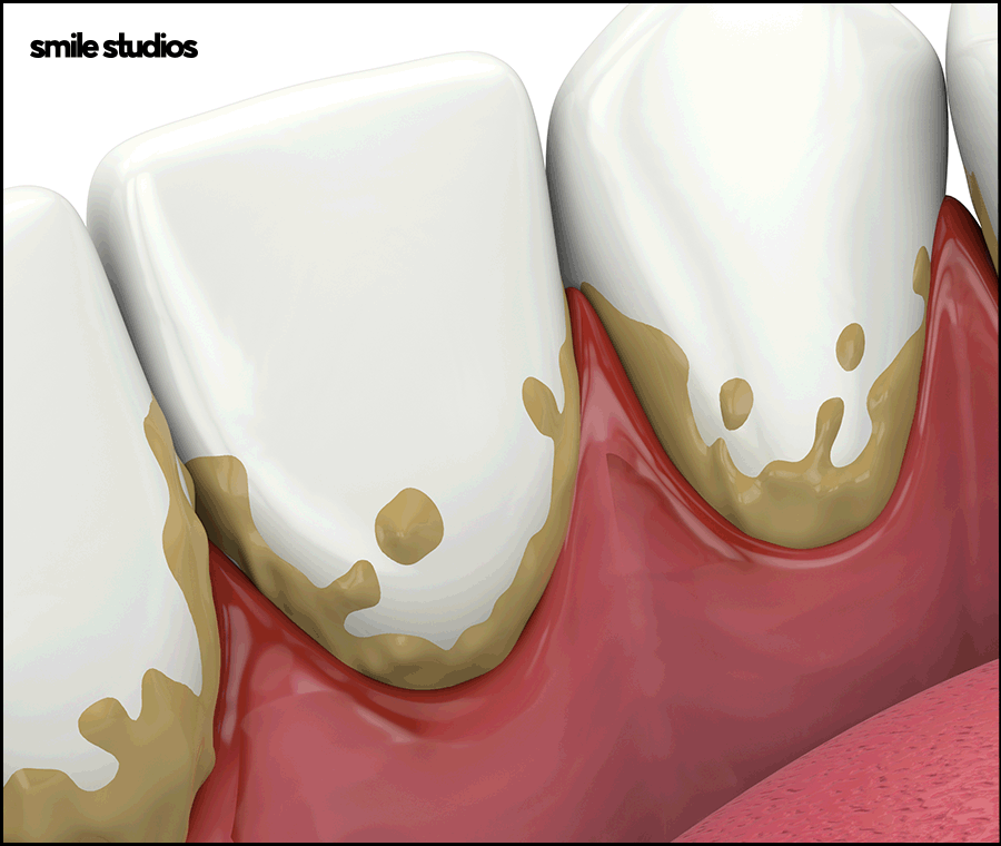 치경부마모증, 주저앉은 잇몸? 원인과 해결 방법 관련 이미지 6