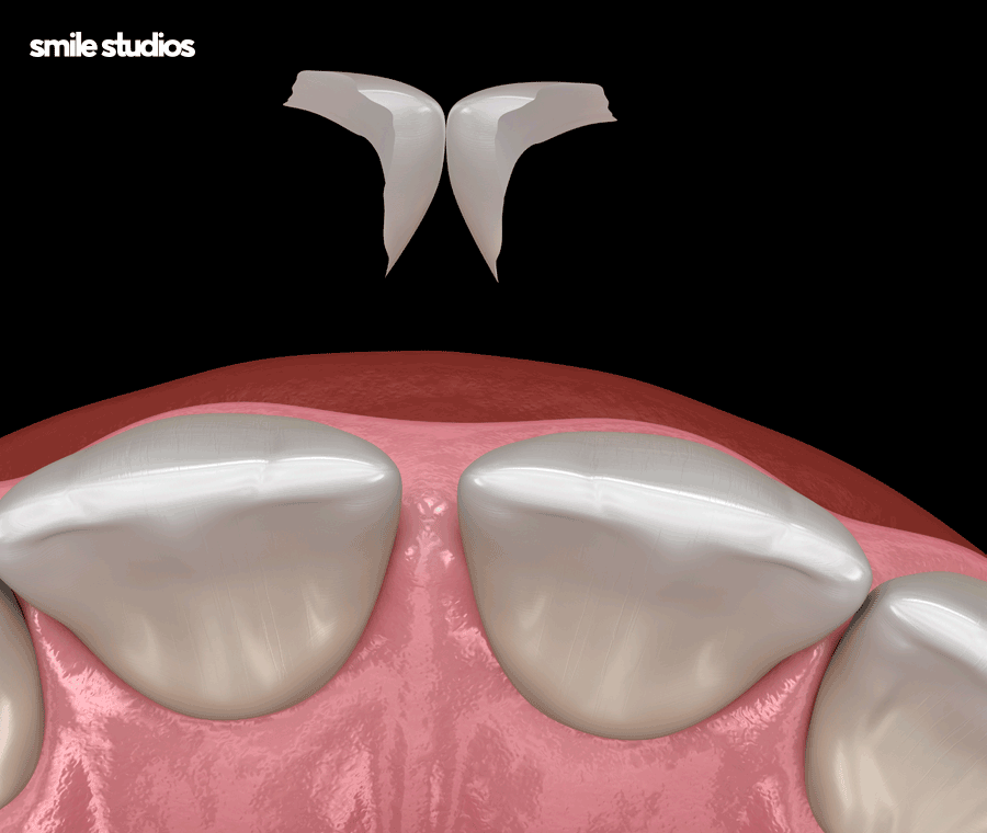 치아 사이 검은색 나타나는 이유, 회복 방법은? 관련 이미지 5