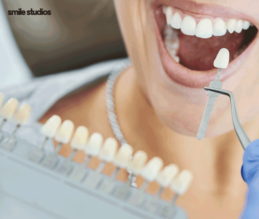 학동역치과 라미네이트 고민된다면 사전에 확인할 점 관련 이미지 5